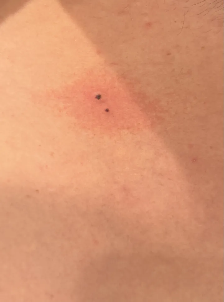 Gros plan sur la peau claire d'un cou avec deux grains de beauté marron visibles près de la clavicule.