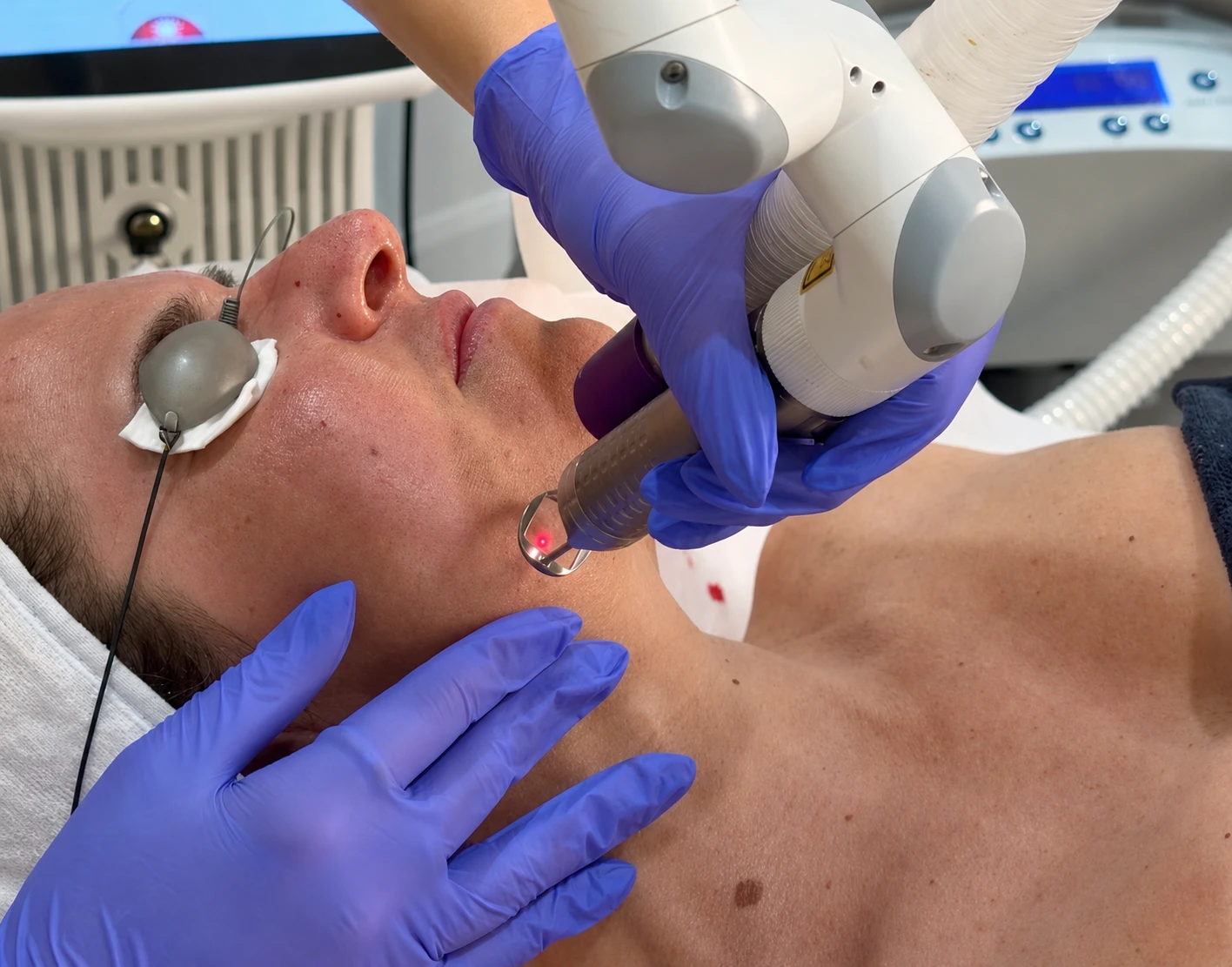 Une personne recevant un soin laser au visage avec un masque oculaire protecteur et des gants violets.