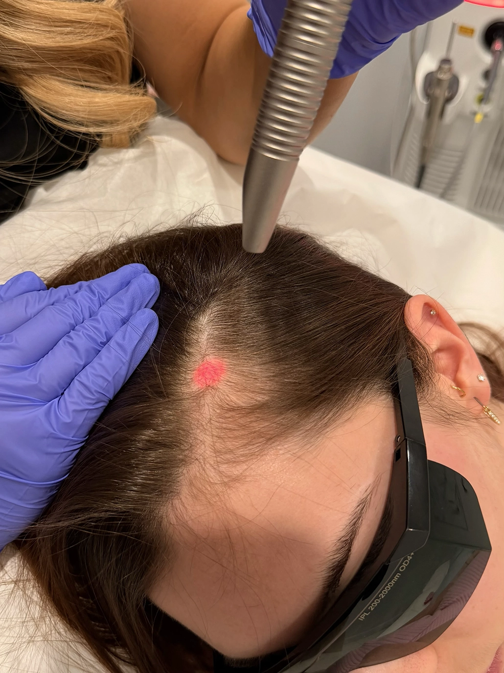 Traitement laser ciblant le cuir chevelu d'une femme portant des lunettes de protection noires.