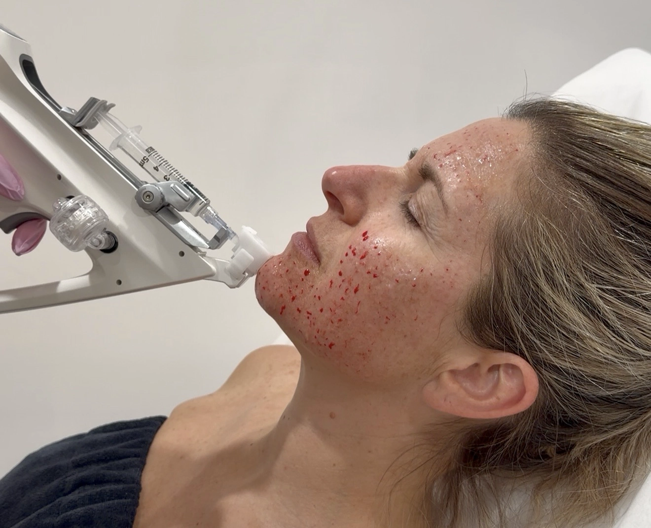 Femme recevant un traitement facial avec un appareil injectant de fines gouttes sur son visage.