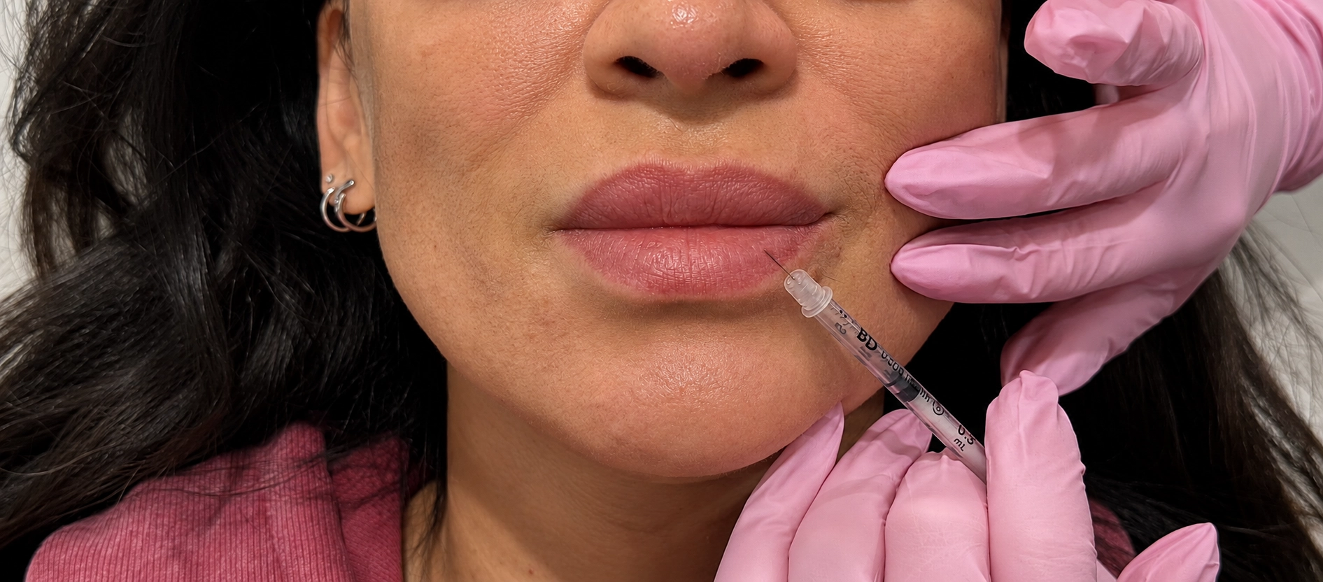 Une personne reçoit une injection au niveau des lèvres, réalisée par des mains gantées de rose.