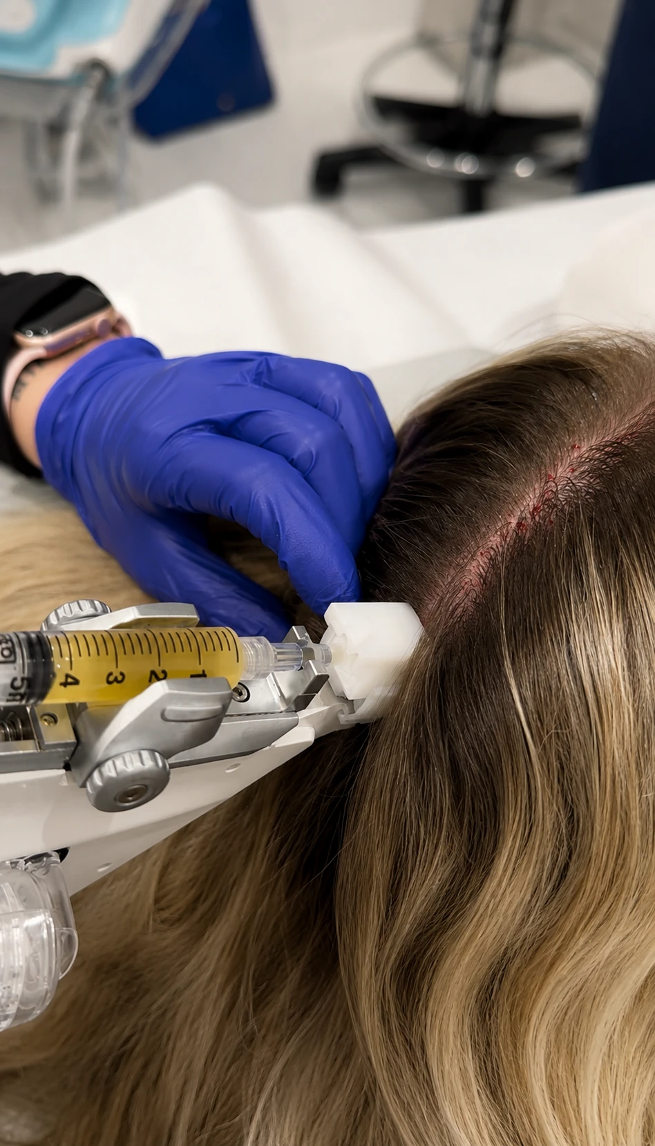 Mains gantées injectant un liquide jaune dans le cuir chevelu d'une personne aux cheveux blonds.