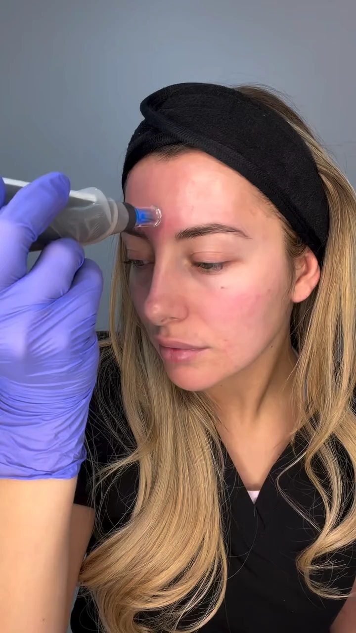 Une femme reçoit un soin du visage avec un dispositif sur le front, porté par une main gantée de violet.
