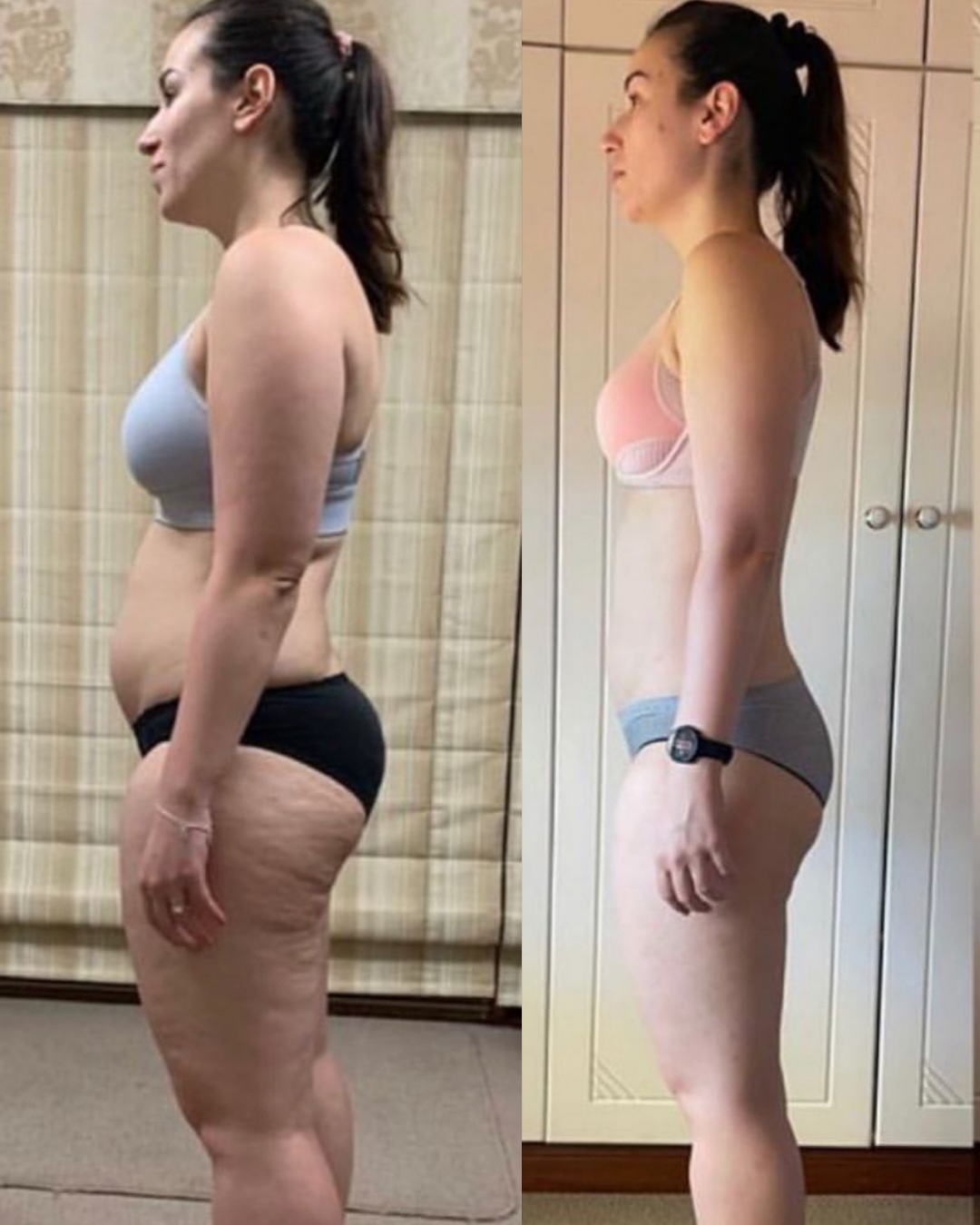 Side-by-side comparison of a woman before and after weight loss, showing reduced body fat and smoother skin.