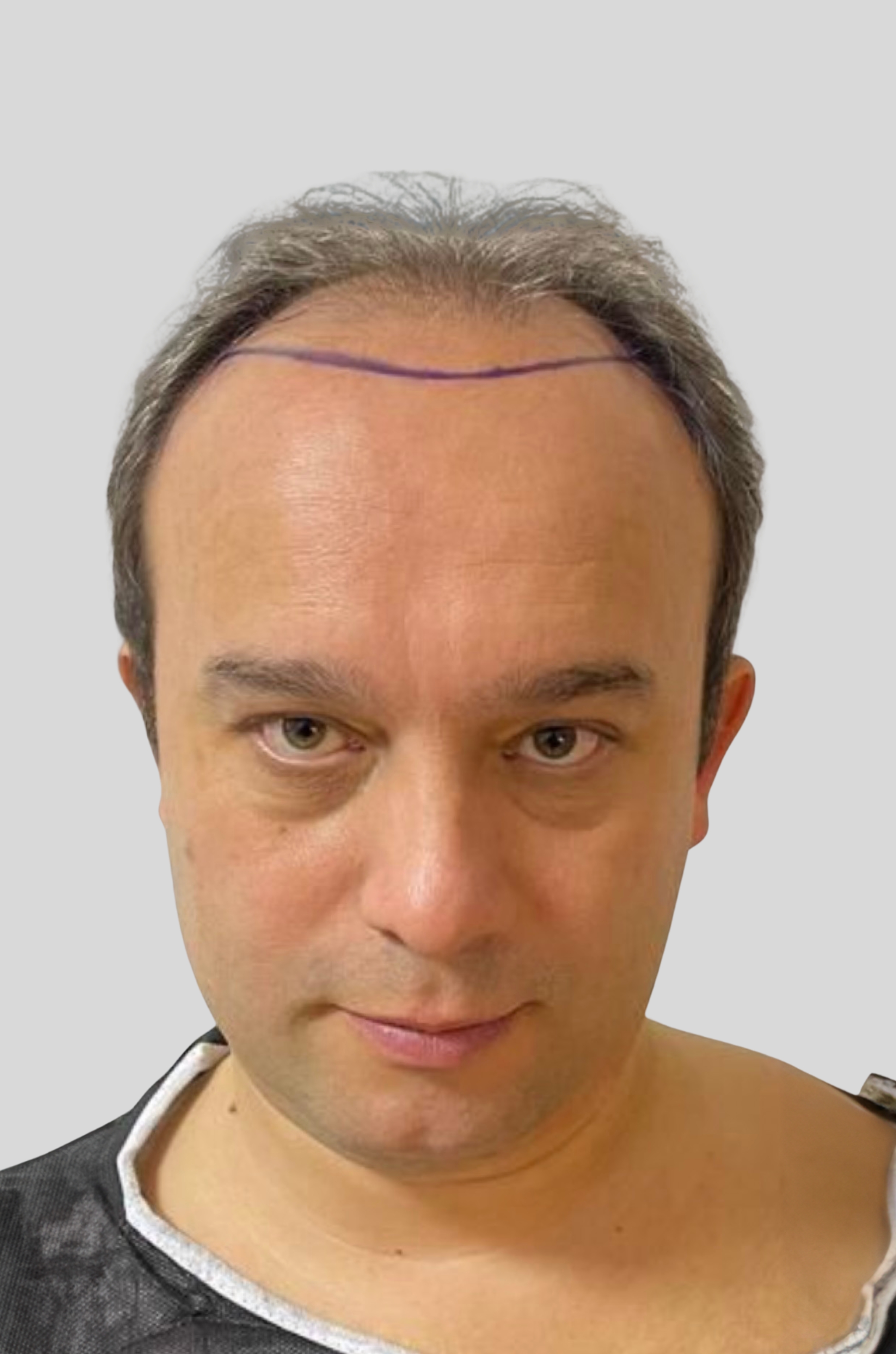 Man with receding hairline and purple line drawn on forehead indicating hairline design.
