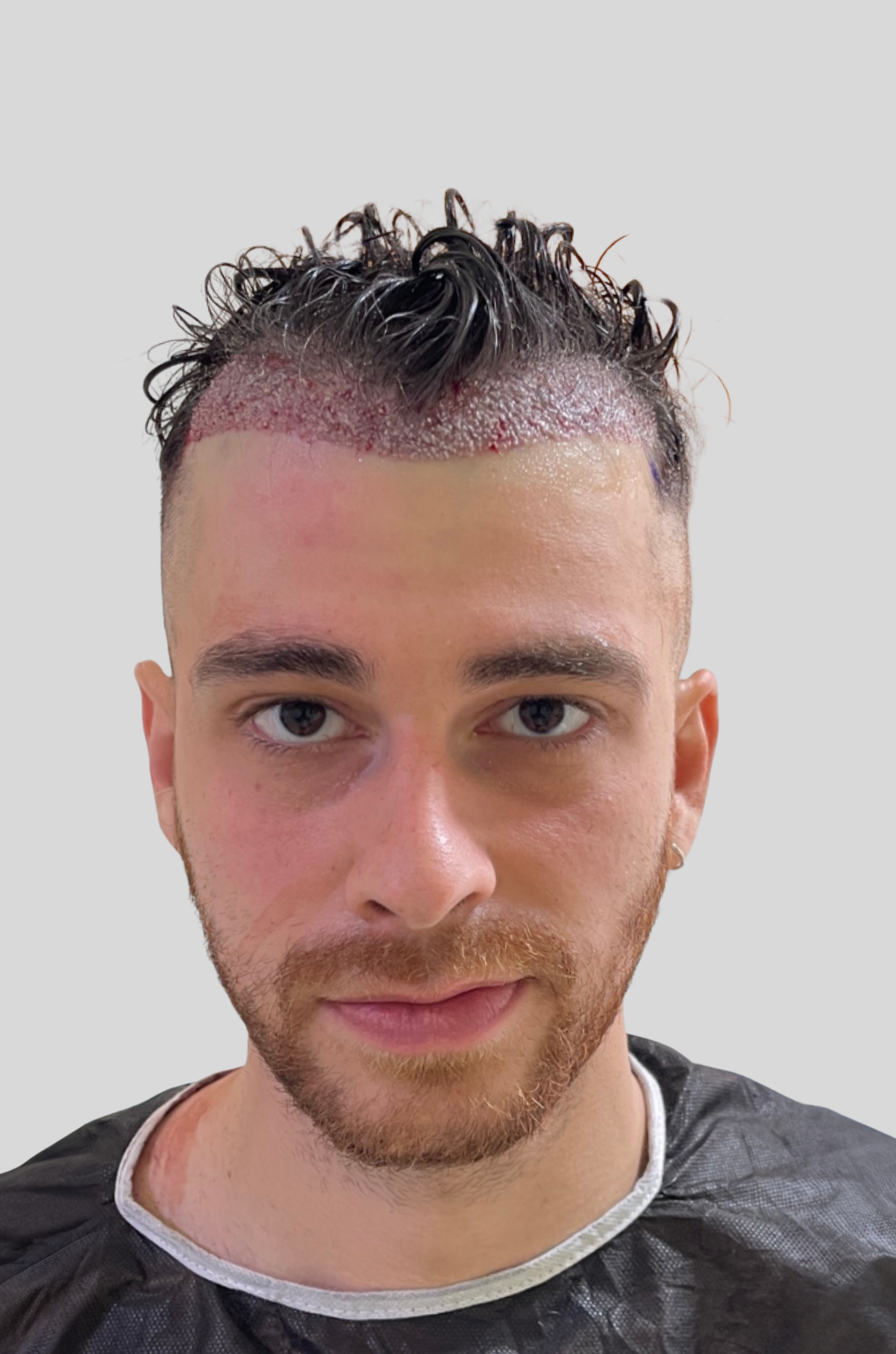 Front portrait of a man with short dark hair showing a fresh hair transplant with visible scabs on his scalp.
