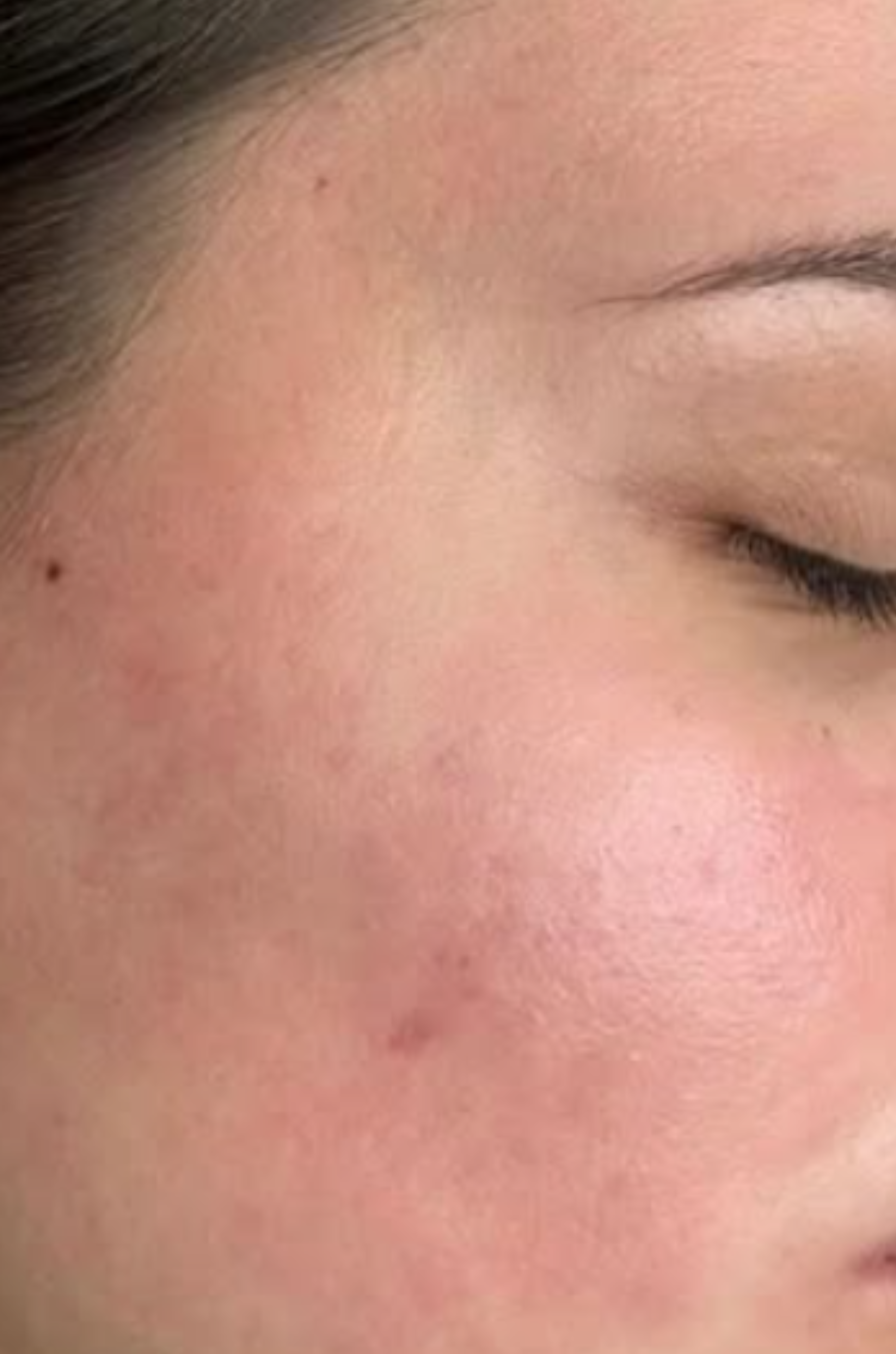 Close-up of a person's cheek with visible redness and acne scarring.