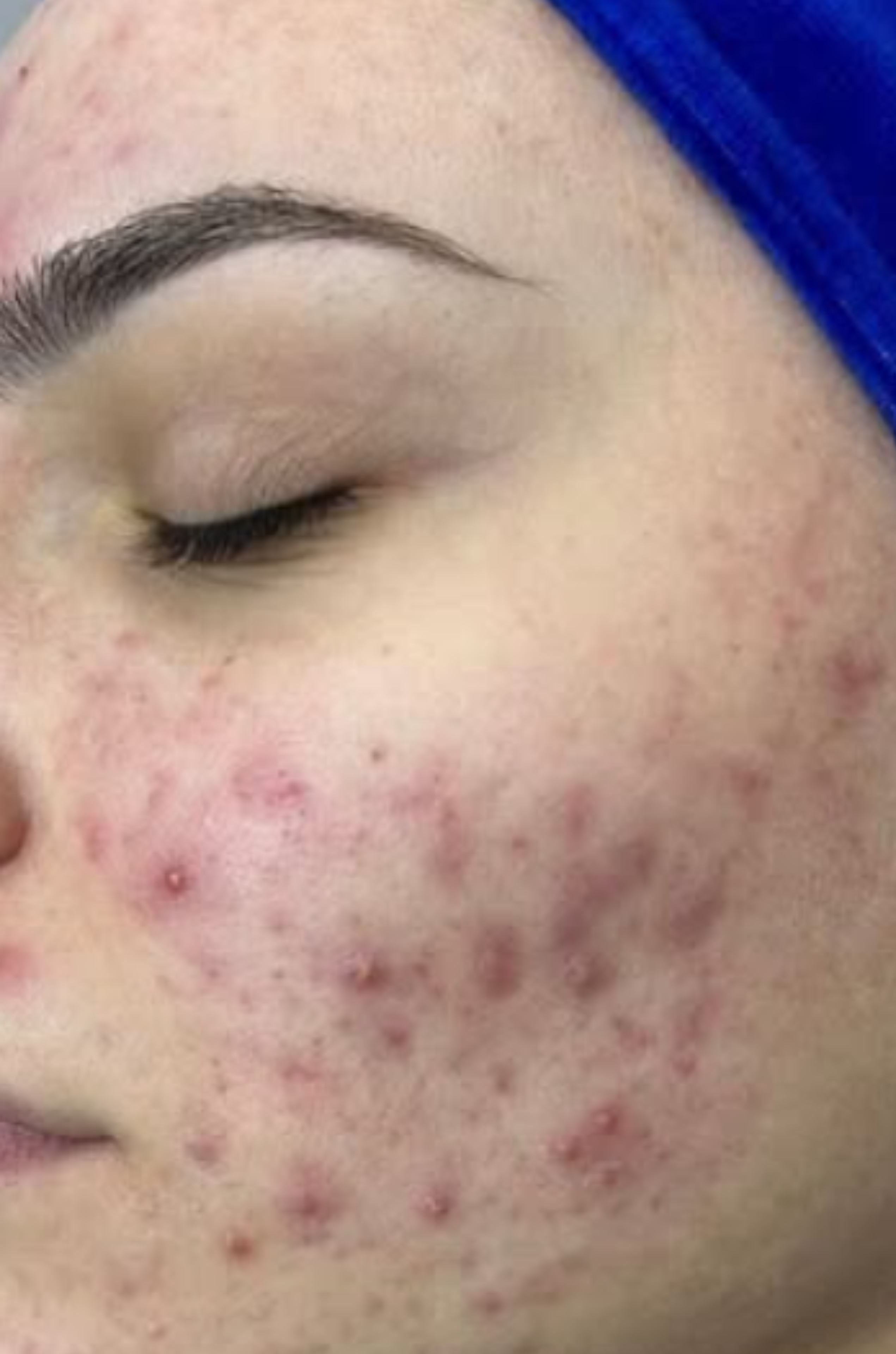Close-up of a person's cheek with red acne and blemishes, eyes closed and wearing a blue head covering.