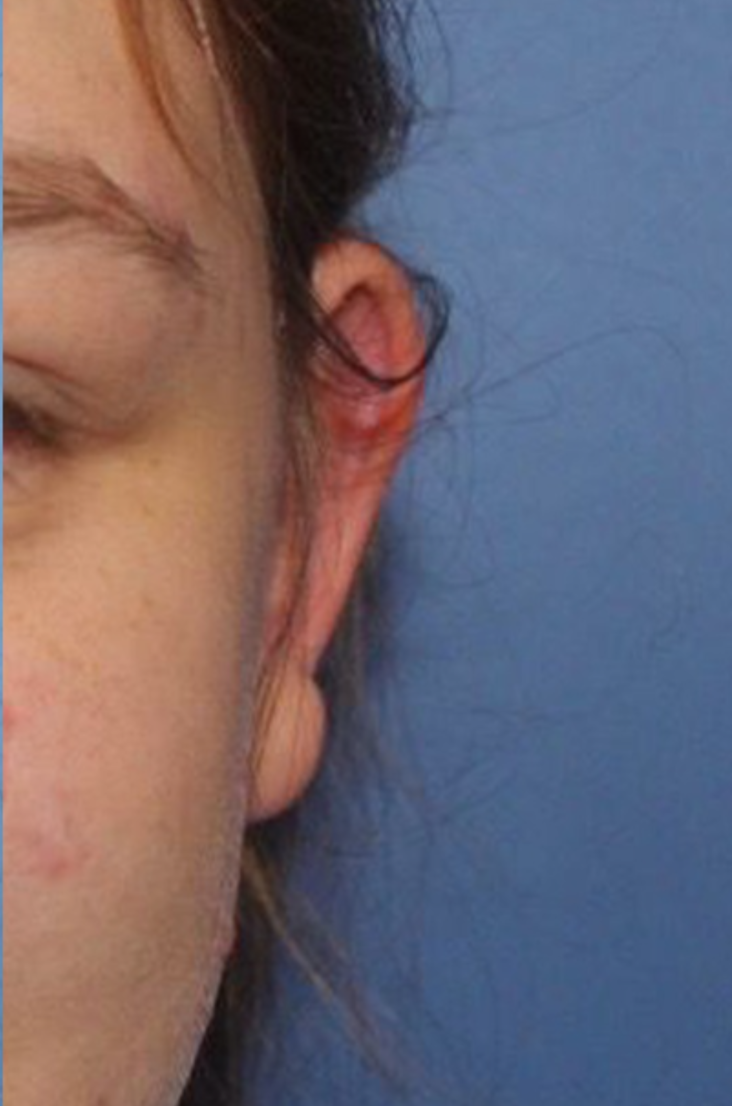 Close-up of a person's left ear with visible redness and irritation near the upper part, against a blue background.
