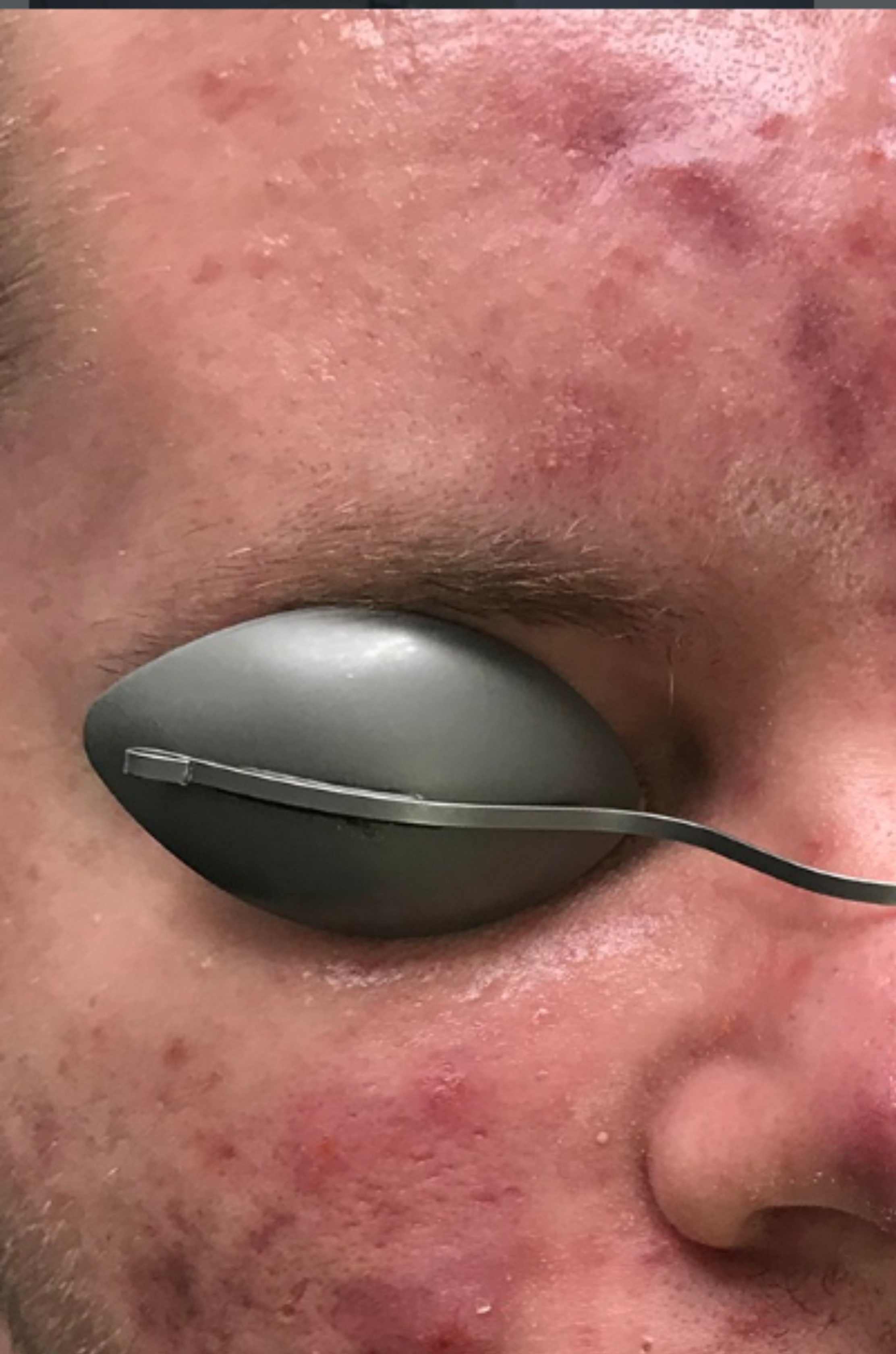 Close-up of a person's face with acne and a dark eye patch covering one eye secured by a thin strap.