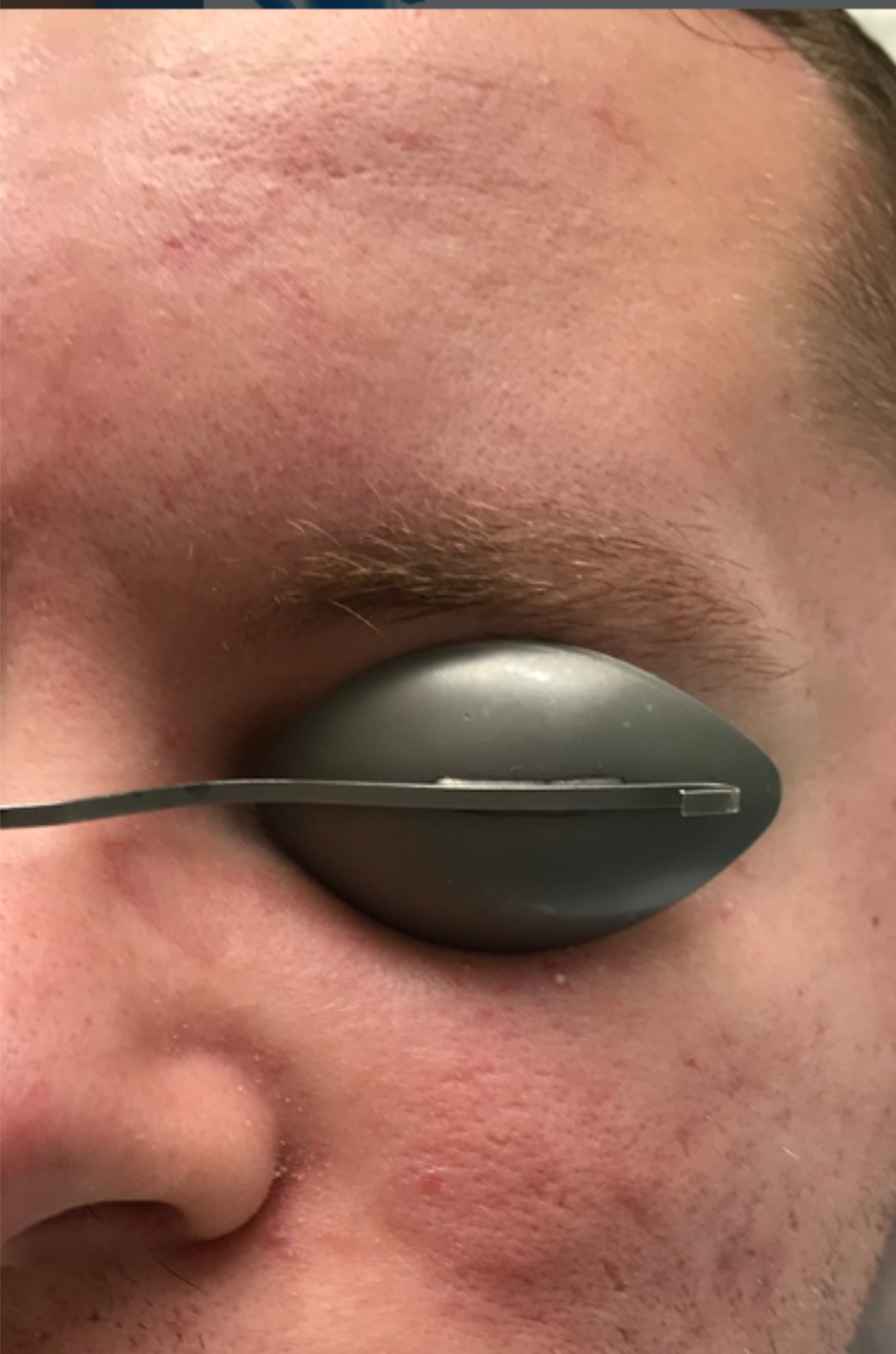 Close-up of a person's face with a gray eye shield covering one eye.