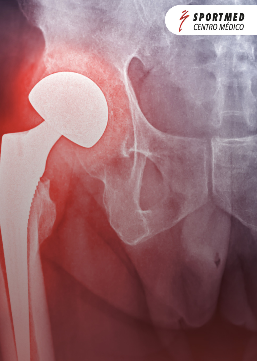 Hip Replacement care at SportMed
