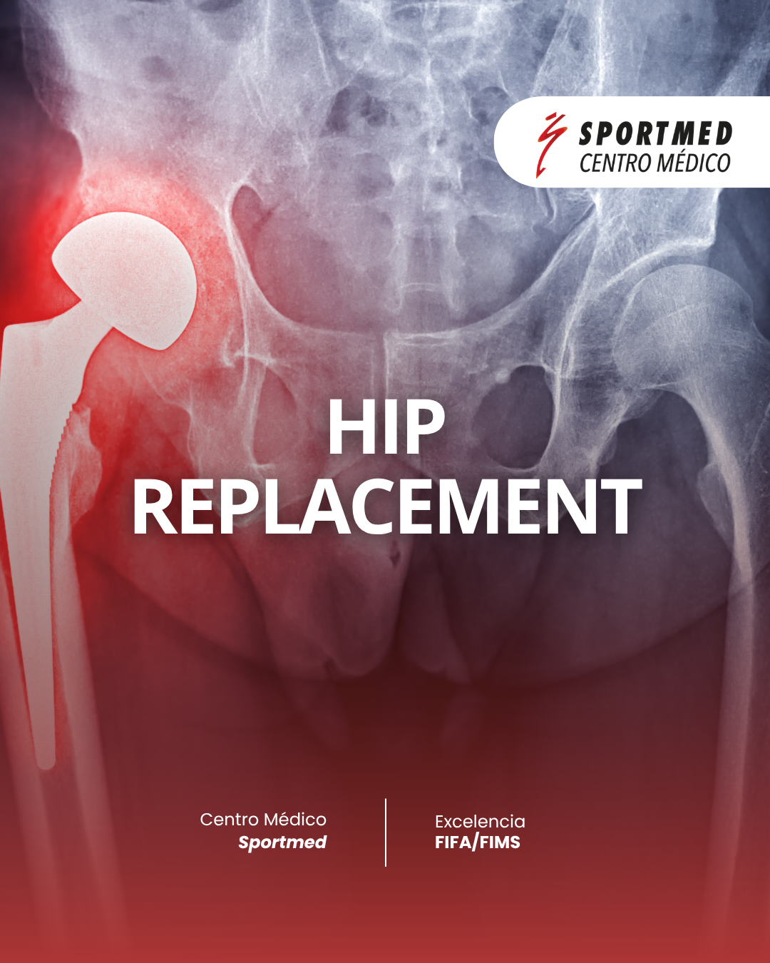 Hip Replacement