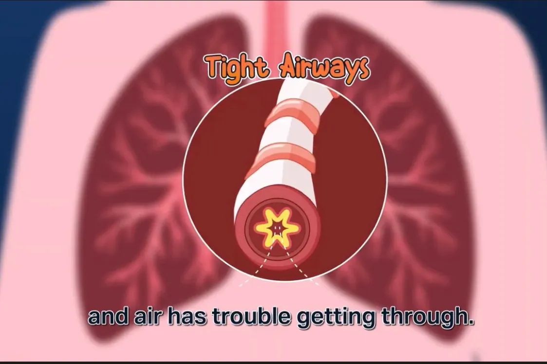 Still from a Qik explainer video showing inflamed airways and trapped air in the lungs