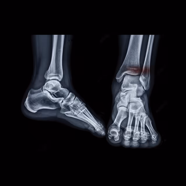 Ankle fracture treatment in Manhasset, NY