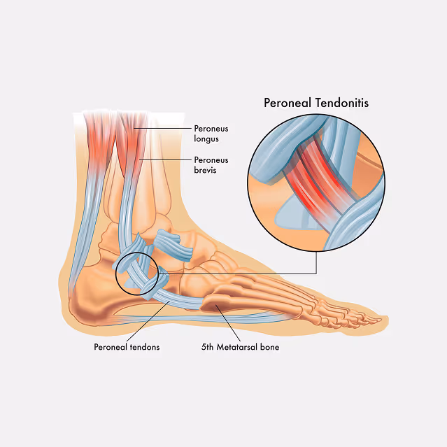 Peroneal Tendonitis Treatment in Manhasset, New York
