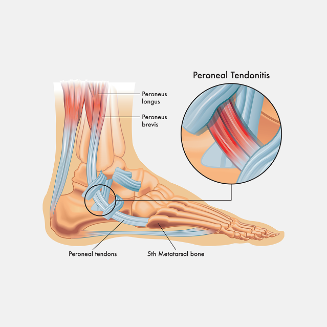 Peroneal Tendonitis Treatment in Manhasset, New York

