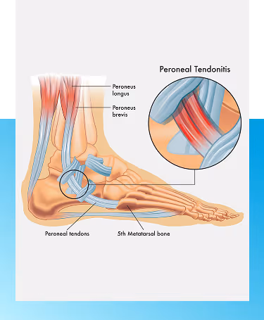 Peroneal Tendonitis Treatment in Manhasset, New York