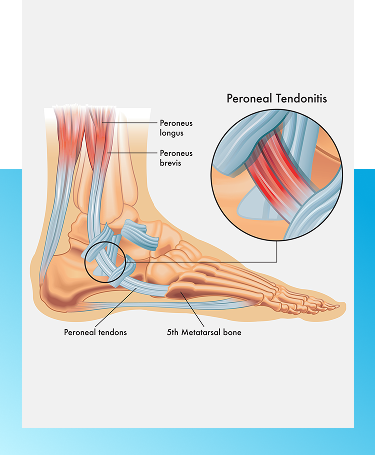 Peroneal Tendonitis Treatment in Manhasset, New York
