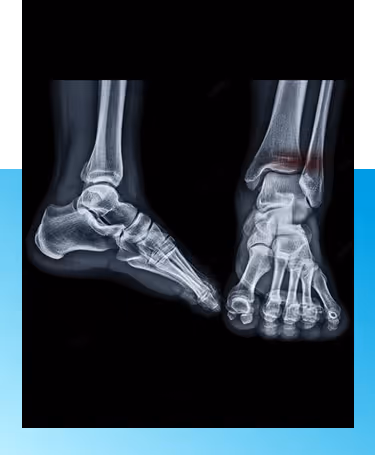 Ankle fracture treatment in Manhasset, NY