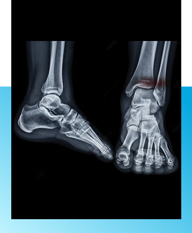 Ankle fracture treatment in Manhasset, NY