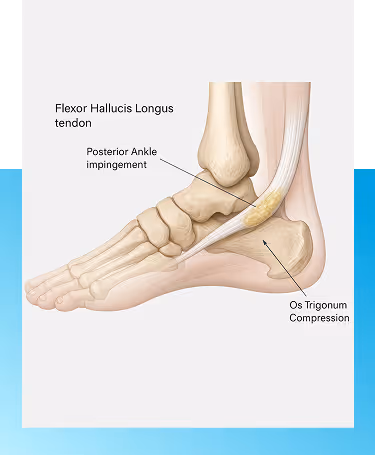 Posterior Ankle Impingement treatment in Manhasset, NY