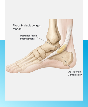 Posterior Ankle Impingement  treatment in Manhasset, NY