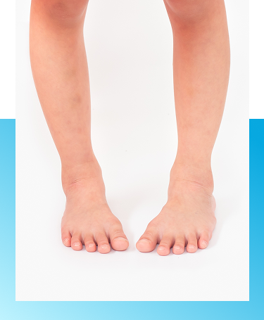 Intoeing foot treatment in Manhasset, NY