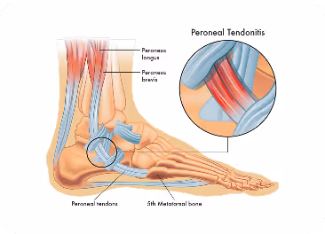 Peroneal Tendonitis Treatment in Manhasset, New York

