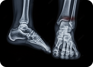 Ankle fracture treatment in Manhasset, NY