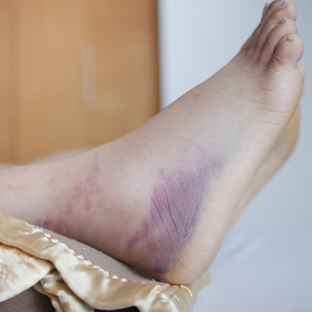 Diabetic wound care treatment in Manhasset, NY