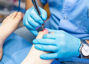 Laser Toenail Fungus Treatment in Manhasset, New York