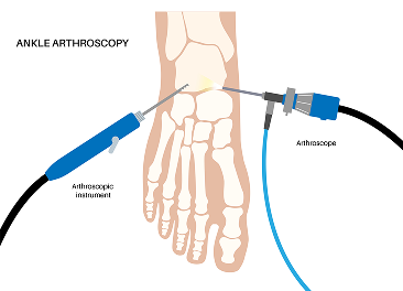 Anterior Ankle Impingement  treatment in Manhasset, NY