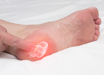 Heel Pain Syndrome treatment in Manhasset, NY