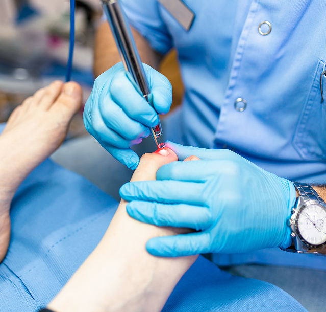 Laser Toenail Fungus Treatment in Manhasset, New York