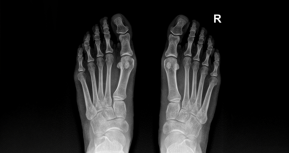 foot x ray showing bones and structure