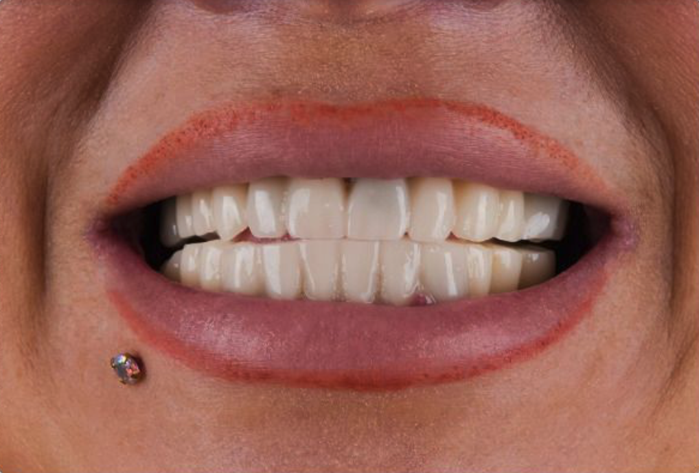 Teeth Whitening result