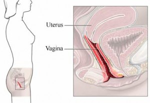 vaginitis