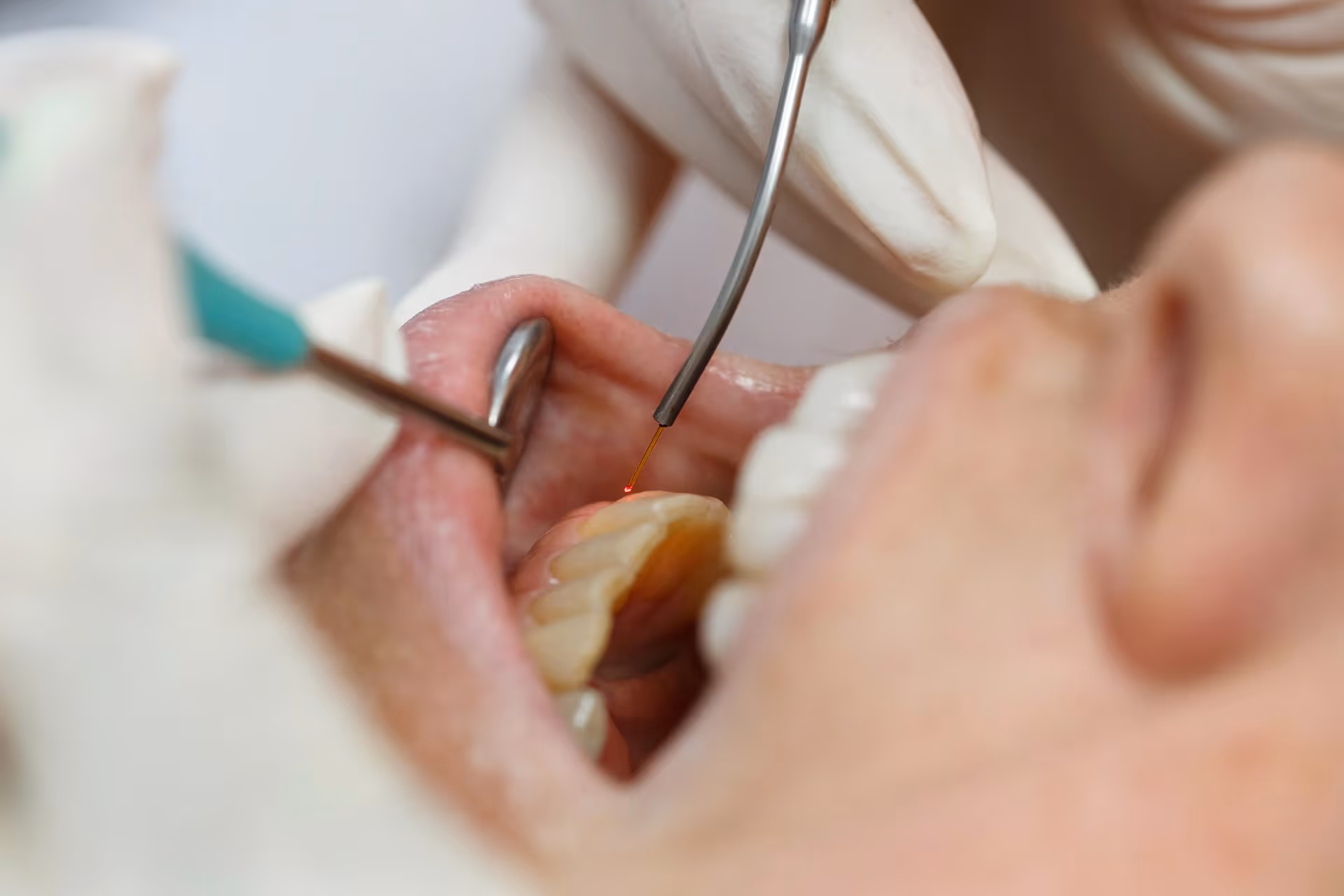 Soft-Tissue Laser Therapy