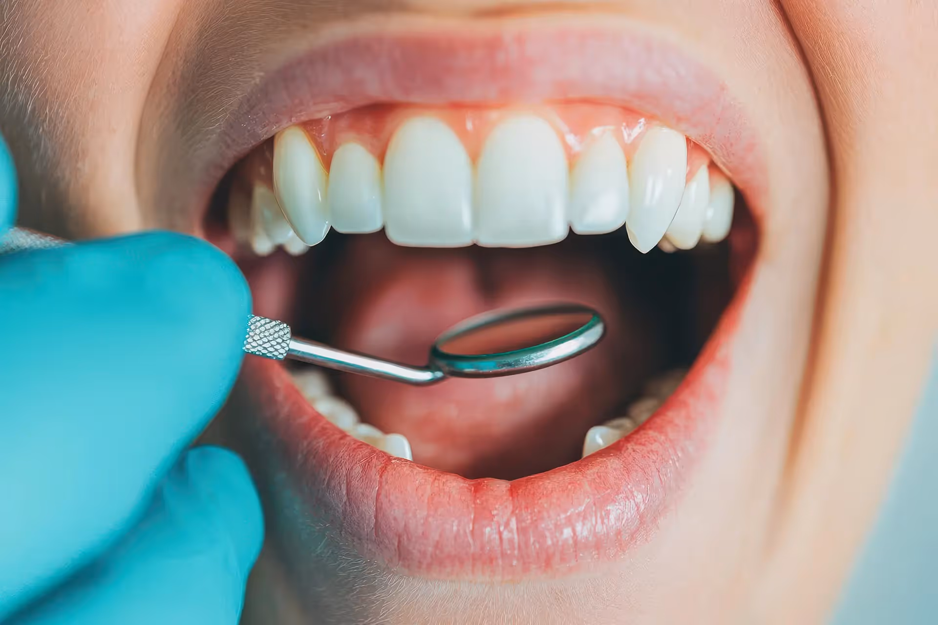 Dental Sealants