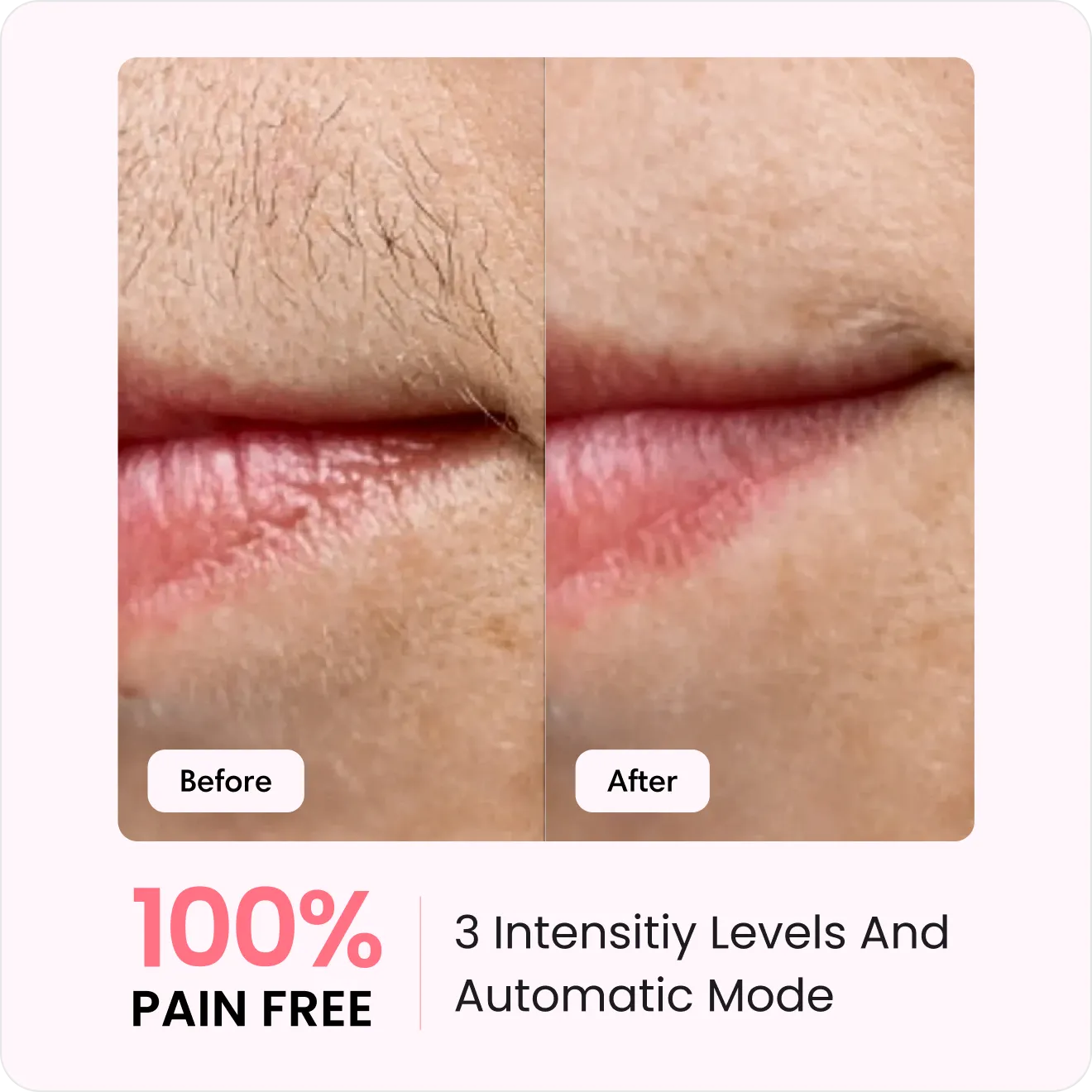 Close-up before and after photos showing hair removal above the upper lip without pain.