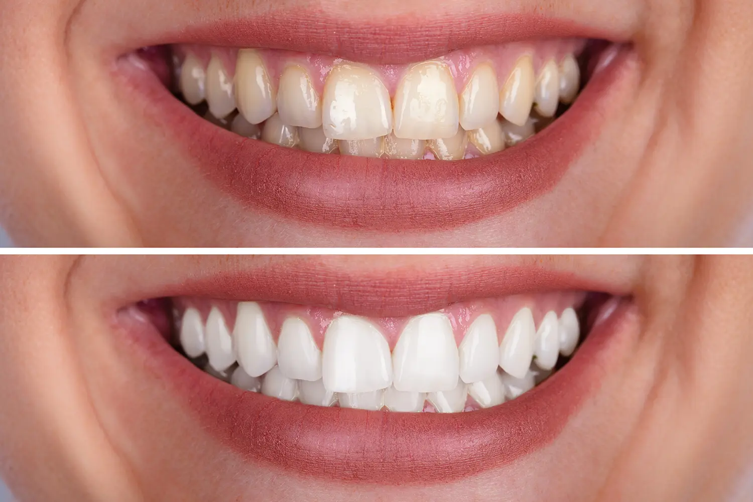 Side-by-side comparison of teeth before and after whitening treatment showing a bright white smile after.