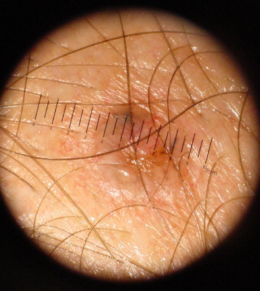 Dermatoskopowe zdjęcie znamienia skórnego