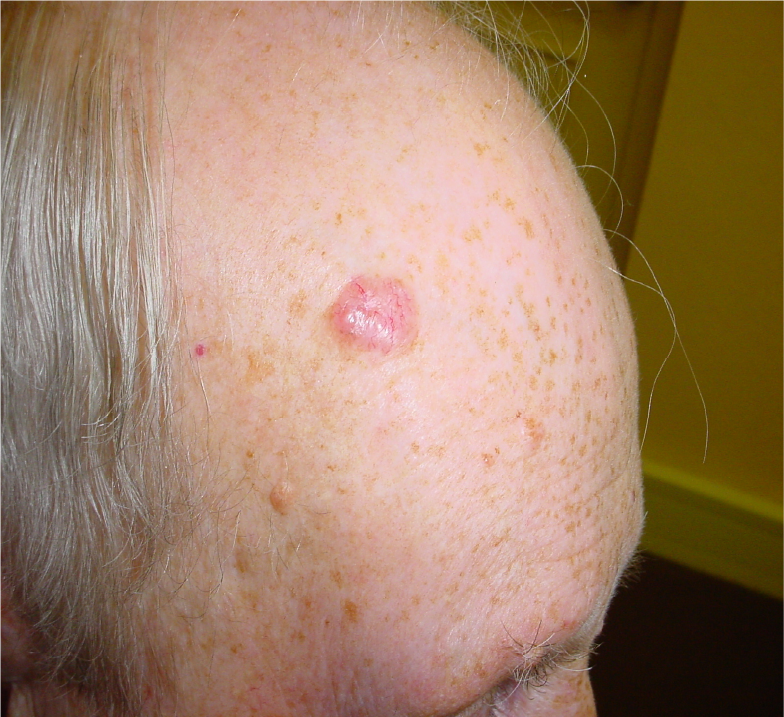 rak_podstawnokomórkowy