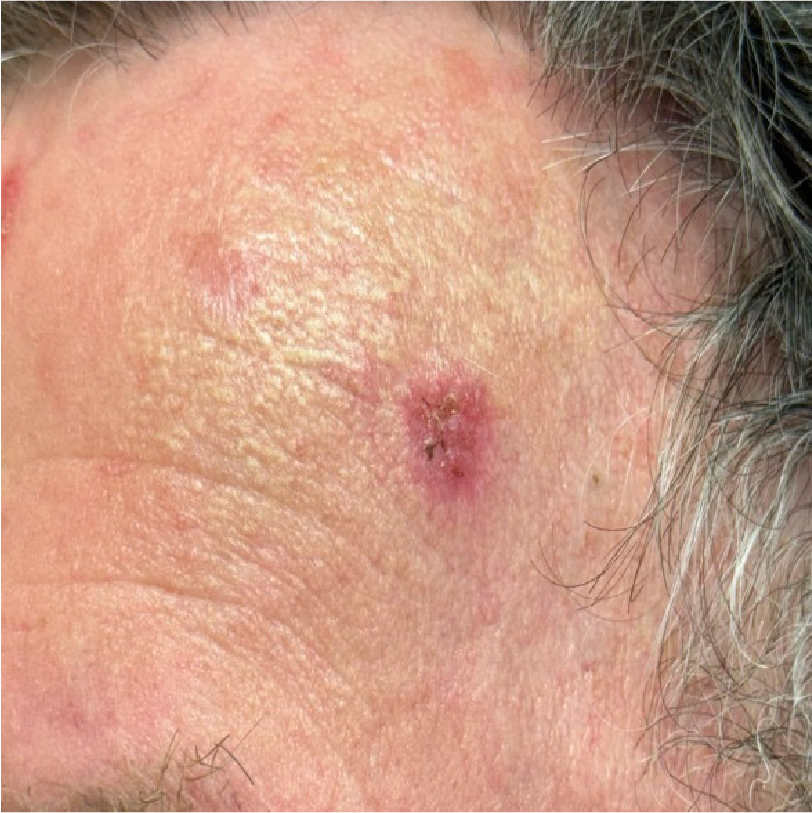 rak kolczystokomórkowy