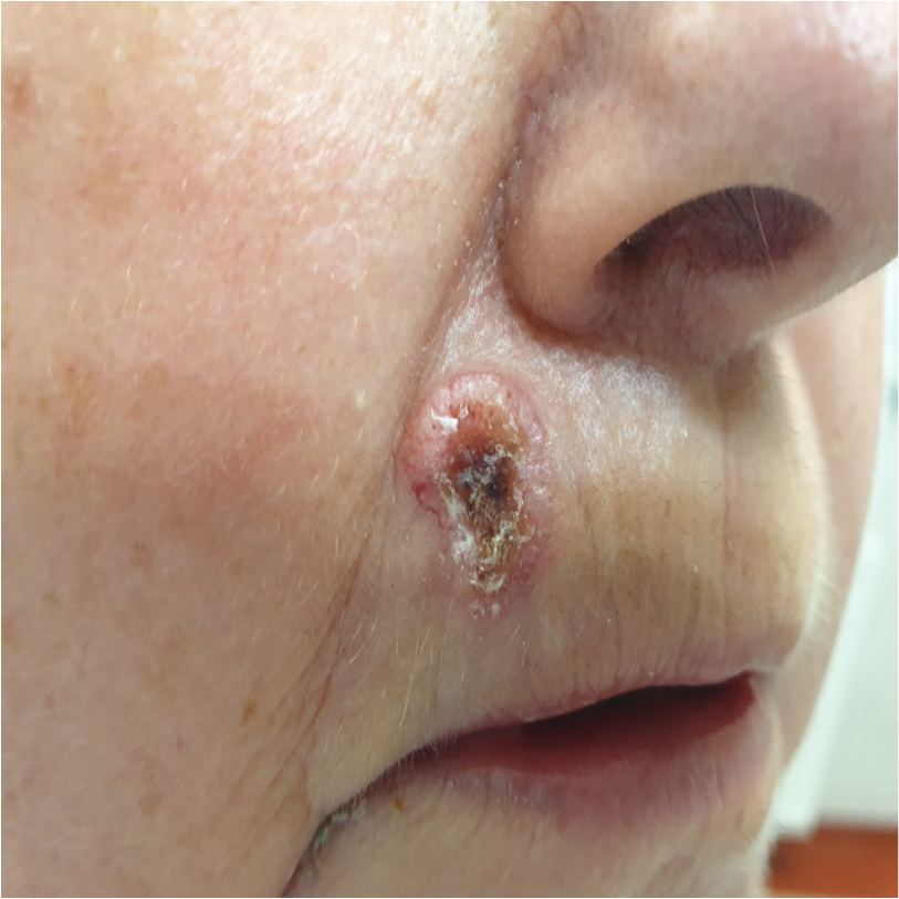 rak_podstawnokomórkowy