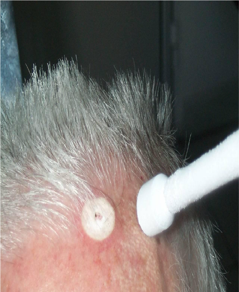 DermedeaClinic - zabieg - krioterapia 