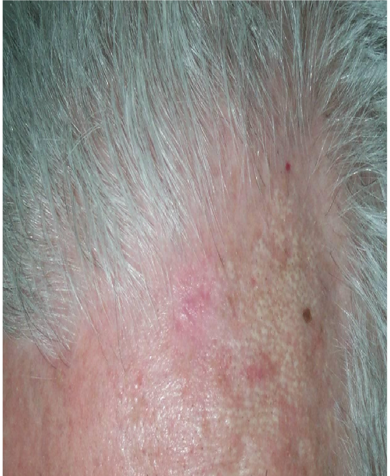 DermedeaClinic - zabieg - krioterapia 