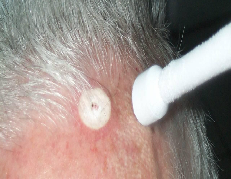 DermedeaClinic - zabieg - krioterapia 