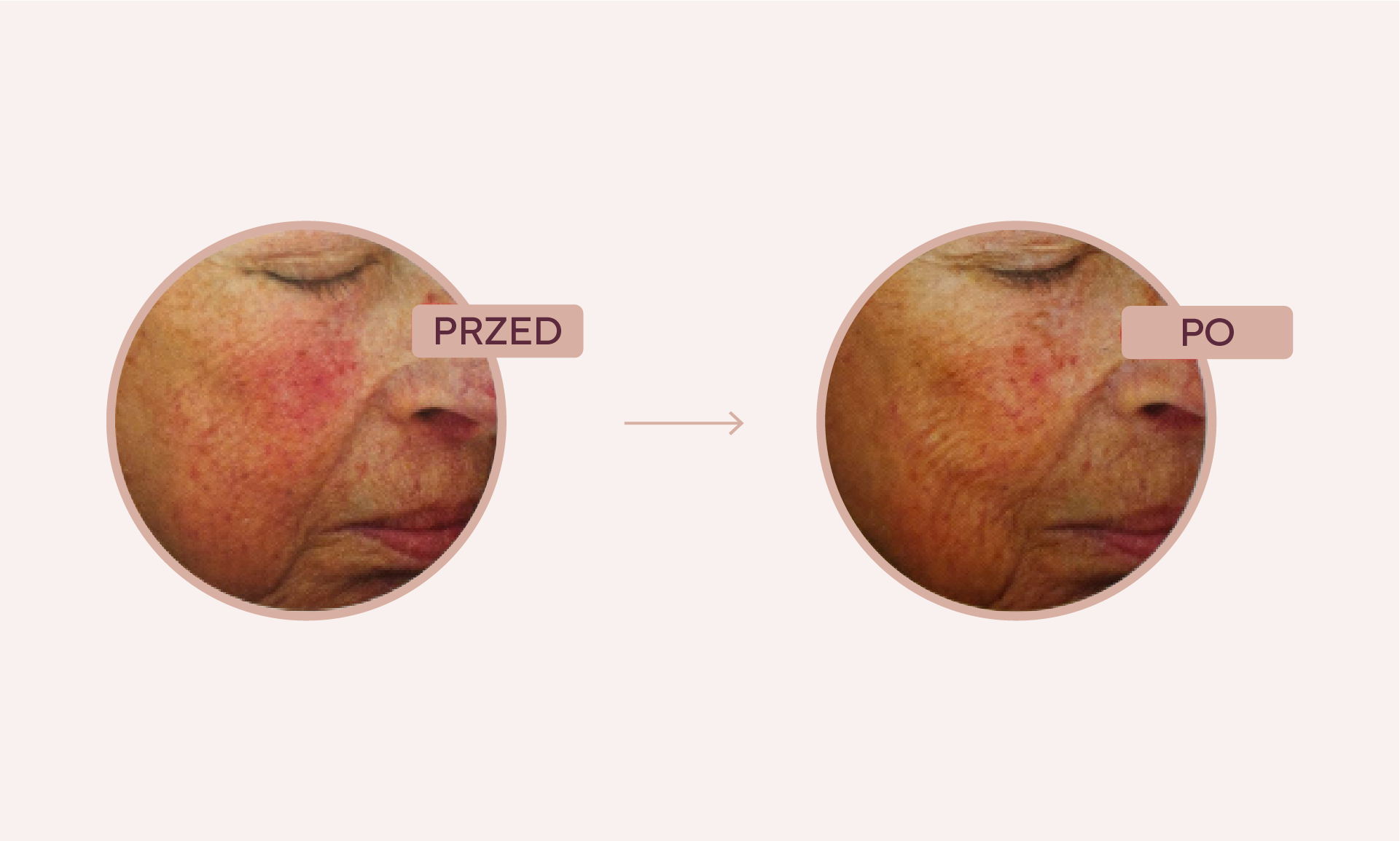 efekty zabiegu rosacure